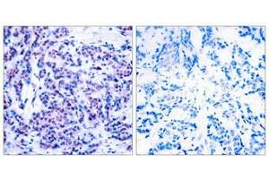 Immunohistochemical analysis of paraffin-embedded human breast carcinoma tissue using JunD(Phospho-Ser255) Antibody(left) or the same antibody preincubated with blocking peptide(right). (JunD Antikörper  (pSer255))