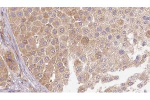 ABIN6272666 at 1/100 staining Human Melanoma tissue by IHC-P. (LTBP1 Antikörper  (C-Term))