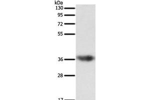 Western Blot analysis of Human liver cancer tissue using SULT1E1 Polyclonal Antibody at dilution of 1:500 (SULT1E1 Antikörper)