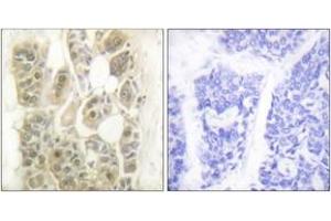 Immunohistochemistry analysis of paraffin-embedded human breast carcinoma tissue, using SSB (Ab-366) Antibody. (SSB Antikörper  (AA 341-390))