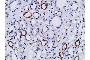 Immunohistochemical staining of paraffin-embedded Human lymphoma tissue using anti-PIK3AP1 mouse monoclonal antibody. (PIK3AP1 Antikörper)