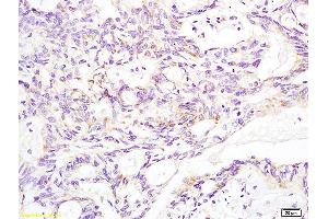 Formalin-fixed and paraffin embedded human rectal carcinoma labeled with Anti-Aldolase A Polyclonal Antibody, Unconjugated (ABIN739800) at 1:200 followed by conjugation to the secondary antibody and DAB staining (Aldolase A, Aldolase B (AA 261-364) Antikörper)