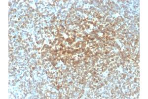 Formalin-fixed, paraffin-embedded human Follicular Lymphoma stained with Bcl-2 Mouse Recombinant Monoclonal Antibody (rBCL2/782). (Rekombinanter Bcl-2 Antikörper)