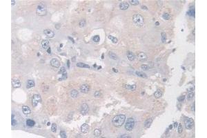 Detection of BCAR1 in Human Breast cancer Tissue using Polyclonal Antibody to Breast Cancer Anti-Estrogen Resistance 1 (BCAR1) (BCAR1 Antikörper  (AA 1-240))