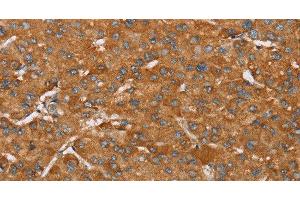 Immunohistochemistry of paraffin-embedded Human liver cancer tissue using PAGE5 Polyclonal Antibody at dilution 1:55 (PAGE5 Antikörper)
