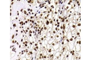 Immunohistochemistry of paraffin-embedded Human kidney cancer using PHIP Polyclonal Antibody at dilution of 1:100 (40x lens). (PHIP Antikörper)
