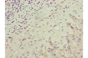 Immunohistochemistry of paraffin-embedded human liver cancer using ABIN7162175 at dilution of 1:100 (OR2H1 Antikörper  (AA 157-193))