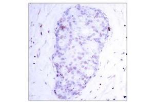 Immunohistochemical analysis of paraffin-embedded human breast carcinoma tissue using NF-κB p105/p50 (phospho-Ser907) antibody (E011019). (NFKB1 Antikörper  (pSer907))