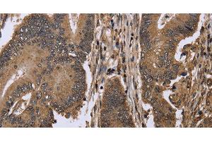 Immunohistochemistry of paraffin-embedded Human colon cancer using EIF3H Polyclonal Antibody at dilution of 1:50 (EIF3H Antikörper)
