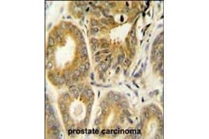 ARL8A Antibody immunohistochemistry analysis in formalin fixed and paraffin embedded human prostate carcinoma followed by peroxidase conjugation of the secondary antibody and DAB staining.
