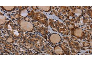 Immunohistochemistry of paraffin-embedded Human thyroid cancer using PAPPA Polyclonal Antibody at dilution of 1:50 (PAPPA Antikörper)