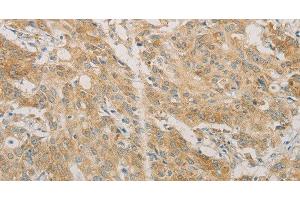 Immunohistochemistry of paraffin-embedded Human gastric cancer using ACSL4 Polyclonal Antibody at dilution of 1:60