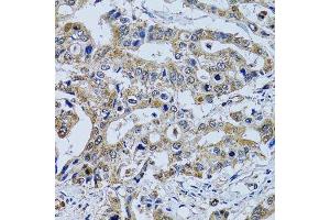 Immunohistochemistry of paraffin-embedded human colon carcinoma using TPPP3 antibody.