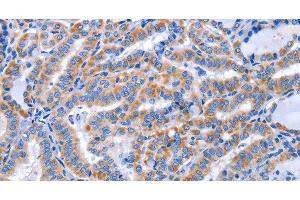 Immunohistochemistry of paraffin-embedded Human thyroid cancer using CCR6 Polyclonal Antibody at dilution of 1:50 (CCR6 Antikörper)