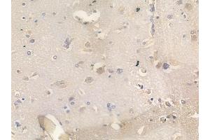 ABIN6266299 and ABIN6277447 at 1/100 staining human glioblastoma by IHC-P. (Neurogenin 1 Antikörper  (Internal Region))
