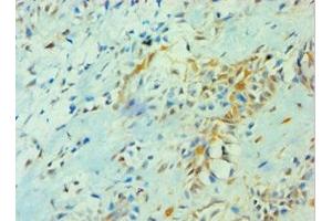 Immunohistochemistry of paraffin-embedded human breast cancer using ABIN7142103 at dilution of 1:100 (14-3-3 theta Antikörper  (AA 1-245))