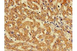 Immunohistochemistry of paraffin-embedded human liver cancer using ABIN7157603 at dilution of 1:100 (KIF17 Antikörper  (AA 500-777))