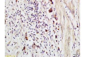 Formalin-fixed and paraffin embedded human colon carcinoma labeled with Anti-CCP Polyclonal Antibody, Unconjugated  at 1:200 followed by conjugation to the secondary antibody and DAB staining