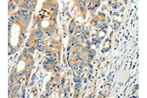 The image on the left is immunohistochemistry of paraffin-embedded Human colon cancer tissue using ABIN7130917(RPAP3 Antibody) at dilution 1/15, on the right is treated with fusion protein. (RPAP3 Antikörper)