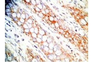 Human colon cancer tissue was stained by Rabbit Anti-CCK-33  (Human,Rat) Antibody