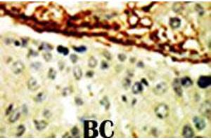 Formalin-fixed and paraffin-embedded human cancer tissue reacted with EPHA4 polyclonal antibody  , which was peroxidase-conjugated to the secondary antibody, followed by DAB staining. (EPH Receptor A4 Antikörper  (AA 40-70))