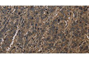 Immunohistochemistry of paraffin-embedded Human liver cancer using GSTO1 Polyclonal Antibody at dilution of 1:60 (GSTO1 Antikörper)
