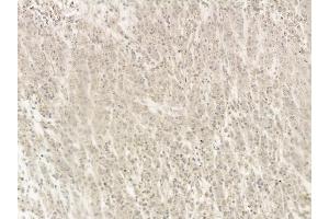 p53 Mouse Monoclonal Antibody at 1/100 staining human gastric cancer and adjacent non-tumor tissue by IHC-P.