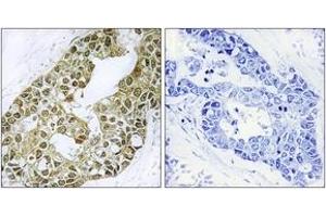 Immunohistochemistry analysis of paraffin-embedded human breast carcinoma tissue, using IkappaB-alpha (Ab-42) Antibody. (NFKBIA Antikörper  (AA 9-58))