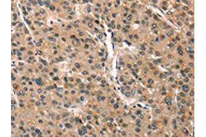 The image on the left is immunohistochemistry of paraffin-embedded Human liver cancer tissue using ABIN7190351(CRIM1 Antibody) at dilution 1/25, on the right is treated with synthetic peptide. (CRIM1 Antikörper)