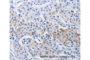 Immunohistochemistry of Human lung cancer using LRIG1 Polyclonal Antibody at dilution of 1:120 (Lrig1 Antikörper)