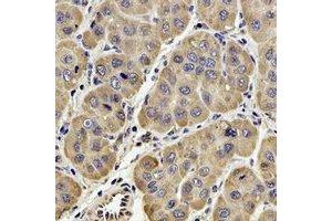 Immunohistochemical analysis of GPx-4 staining in human liver cancer formalin fixed paraffin embedded tissue section.