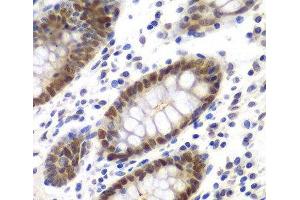Immunohistochemistry of paraffin-embedded Human colon using MSH6 Polyclonal Antibody at dilution of 1:100 (40x lens).