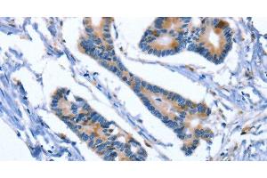 Immunohistochemistry of paraffin-embedded Human colon cancer using IBSP Polyclonal Antibody at dilution of 1:50 (IBSP Antikörper)
