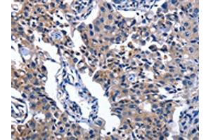 The image on the left is immunohistochemistry of paraffin-embedded Human lung cancer tissue using ABIN7130344(NAT8 Antibody) at dilution 1/50, on the right is treated with fusion protein. (NAT8 Antikörper)