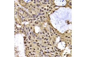 Immunohistochemistry of paraffin-embedded human oophoroma using ARID3A antibody (ABIN5975618) at dilution of 1/100 (40x lens). (ARID3A Antikörper)
