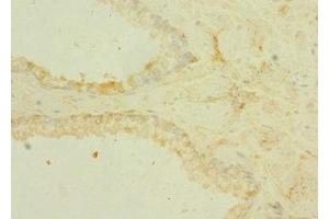 Immunohistochemistry of paraffin-embedded human prostate cancer using ABIN7172868 at dilution of 1:100 (TRPM6 Antikörper  (AA 740-840))