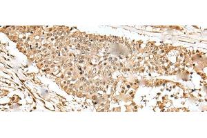 Immunohistochemistry of paraffin-embedded Human colorectal cancer tissue using EEF1E1 Polyclonal Antibody at dilution of 1:35(x200) (EEF1E1 Antikörper)