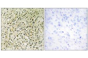 Immunohistochemistry analysis of paraffin-embedded human prostate carcinoma tissue, using RHG07 antibody. (DLC1 Antikörper  (N-Term))