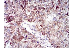 Immunohistochemical analysis of paraffin-embedded liver cancer tissues using UBE2C mouse mAb with DAB staining. (UBE2C Antikörper  (AA 1-179))