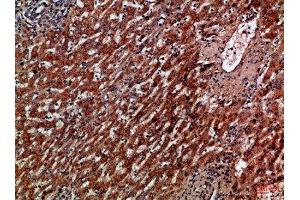 Immunohistochemical analysis of paraffin-embedded Human-liver-cancer, antibody was diluted at 1:100 (CXCR1 Antikörper  (AA 1-50))