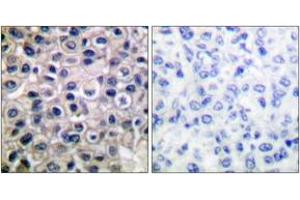 Immunohistochemistry analysis of paraffin-embedded human breast carcinoma tissue, using MMP-14 Antibody. (MMP14 Antikörper  (AA 471-520))