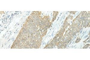 Immunohistochemistry of paraffin-embedded Human esophagus cancer tissue using ETAA1 Polyclonal Antibody at dilution of 1:25(x200) (ETAA1 Antikörper)