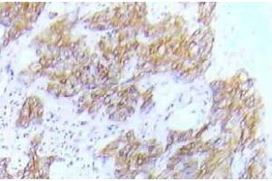 Immunohistochemistry (IHC) analyzes of p-FLT3 antibody in paraffin-embedded human lung adenocarcinoma tissue. (FLT3 Antikörper  (pTyr591))