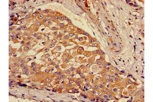 Immunohistochemistry of paraffin-embedded human breast cancer using ABIN7154002 at dilution of 1:100 (GCLM Antikörper  (Regulatory Subunit))
