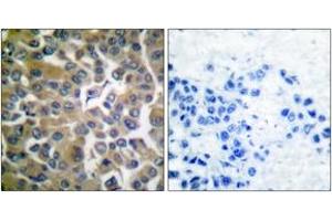 Immunohistochemistry analysis of paraffin-embedded human breast carcinoma tissue, using FAP-1 Antibody. (FAP Antikörper  (AA 331-380))