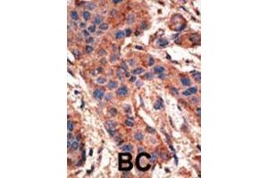 Formalin-fixed and paraffin-embedded human cancer tissue reacted with the primary antibody, which was peroxidase-conjugated to the secondary antibody, followed by AEC staining. (BMPR1A Antikörper  (N-Term))