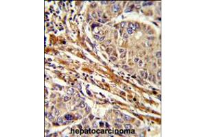 Formalin-fixed and paraffin-embedded human hepatocarcinoma reacted with APRT Antibody , which was peroxidase-conjugated to the secondary antibody, followed by DAB staining. (APRT Antikörper  (C-Term))