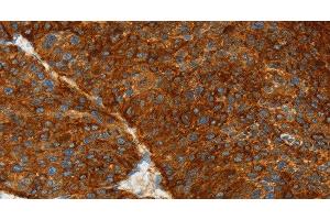 Immunohistochemistry of paraffin-embedded Human liver cancer using ASGR1 Polyclonal Antibody at dilution of 1:50 (Asialoglycoprotein Receptor 1 Antikörper)