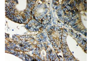 Anti- CD44 Picoband antibody, IHC(P) IHC(P): Human Intestinal Cancer Tissue (CD44 Antikörper  (N-Term))