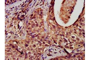 Immunohistochemistry analysis of human cervical cancer using ABIN7150829 at dilution of 1:100 (Dynamin 1-Like Antikörper  (AA 496-710))